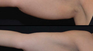 Upper arm after 2 treatments of CoolSculpting Elite