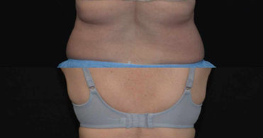 Bra fat after 2 treatments of CoolSculpting Elite