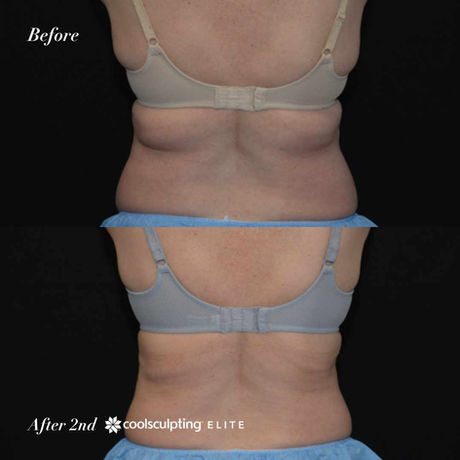 coolsculpting before and after - back fat