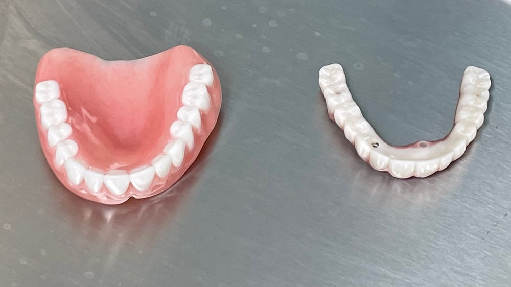 The Advantages of Palateless Dentures A Modern Take on Traditional Solutions