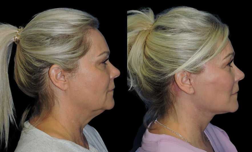 Female patient with visible facelift improvements in side view comparison. Treated in Shreveport by Dr. Kenneth Sanders.