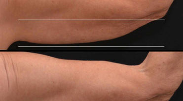 Upper arm after 2 treatments of CoolSculpting Elite