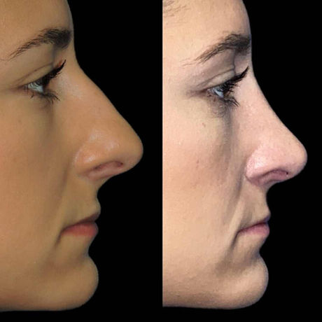 Female Rhinoplasty before & after side view