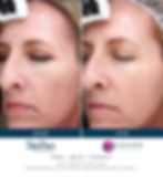 Before and After Picture SkinPen Microneedling Fine Lines