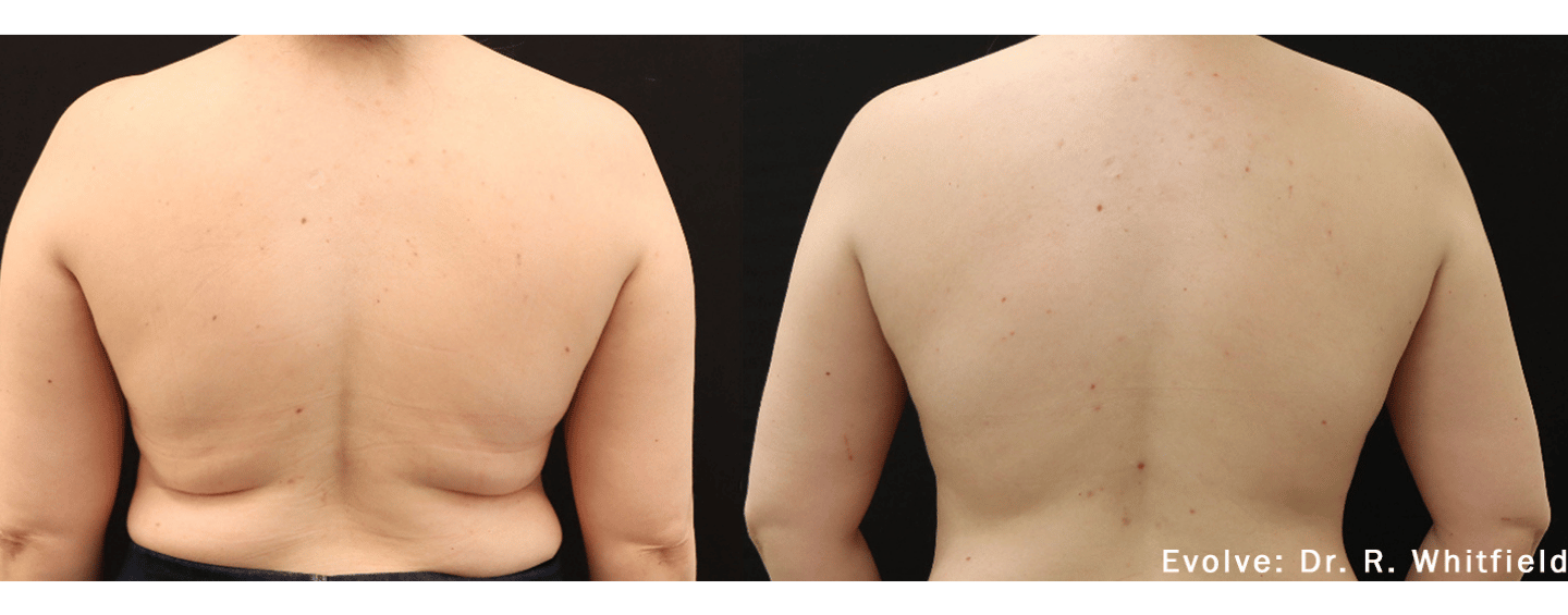 Evolve Before and After Picture