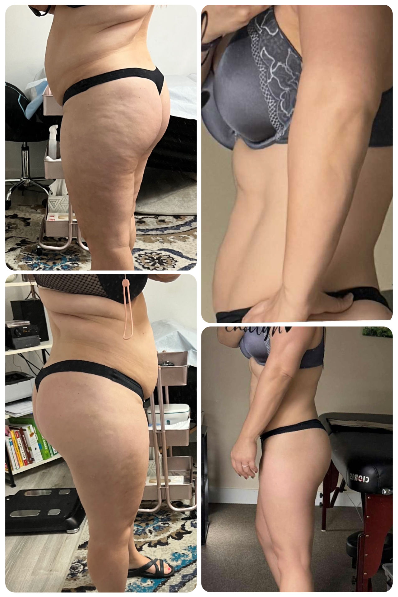 Morpheus8 Tightening and DeBulking 
