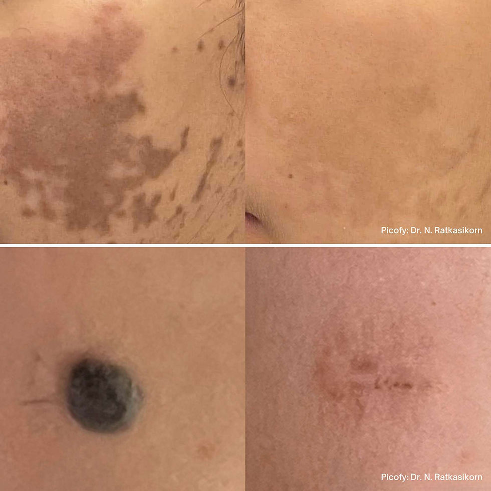 picofy pico laser before and after mole removal birthmark removal