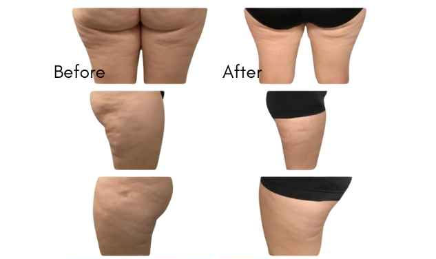 cryo on thighs results