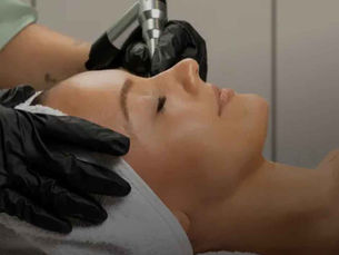 microchanneling treatment
