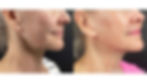 Morpheus8 radiofrequency microneedling before and after results