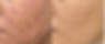 Picofy acne scars. By DR. N. RATKASIKORN