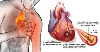 80% des crises cardiaques pourraient être évitées si tout le monde faisait ceci