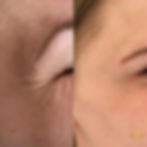 botox, anti wrinkle, crows feet, forehead, frown, lines