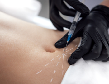 Լիպոլիտիկներ․ ի՞նչ են դրանք և ինչպե՞ս են օգնում նվազեցնել ճարպային կուտակումները