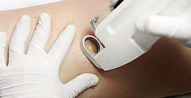 Nd:YAG neodymium laser hair removal