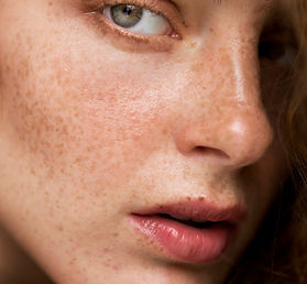 Anti-pigmentation laser treatment