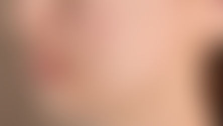 Acne: Discover the power of essential oils for treating acne