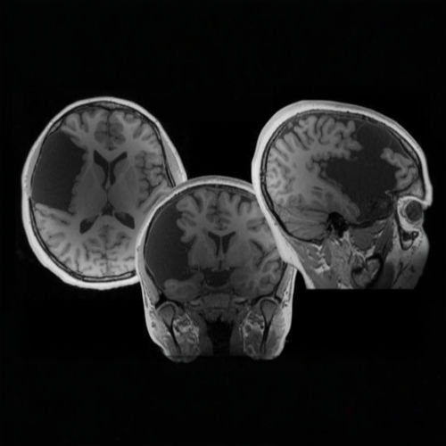 Garrett's post surgery mri showing three views of his brain.