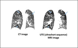 Lung imaging - Air Trapping MRI