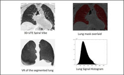 Lung imaging - emphysema