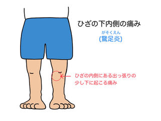 膝の内側の痛み