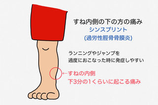 シンスプリント