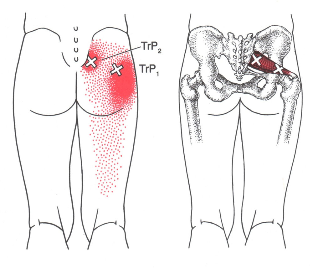 Trigger Point Pain In The Lower Back: Lower Back Pain #1