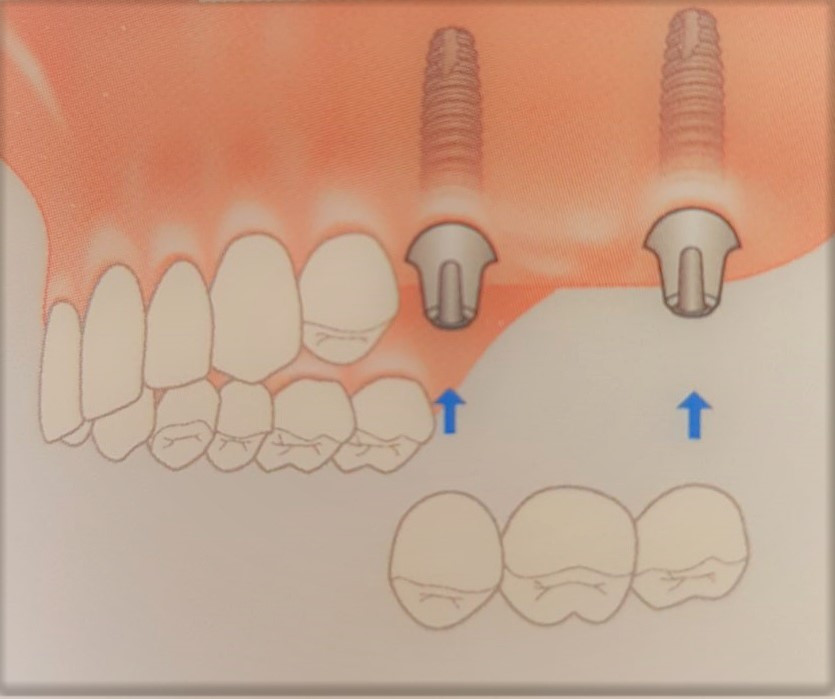 dental implants