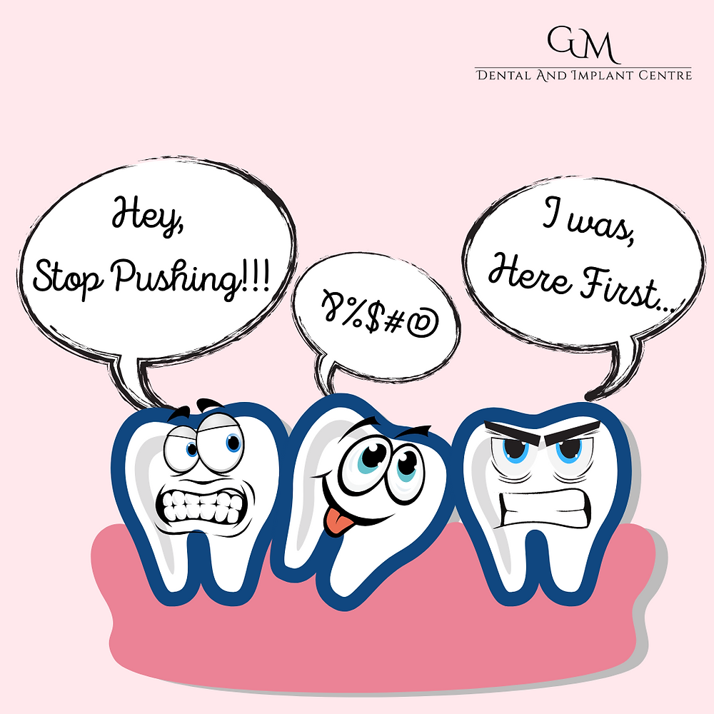 Crowding teeth