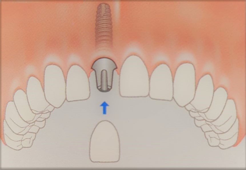 dental implants
