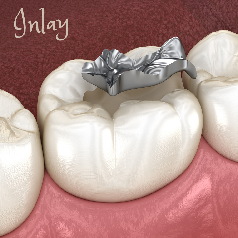 Dental Inlay VS Onlay VS Crown GMDental & Implant Centre Rochester
