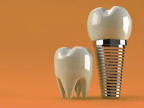 Implantes dentários são resistentes?