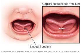 Tongue Tie & Baby Health