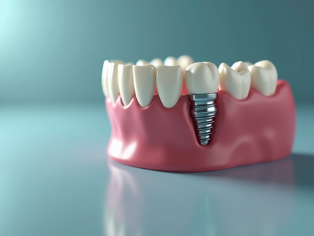 Implant-Supported Dentures vs Traditional Dentures: Key Considerations for Patients in Gulfport MS