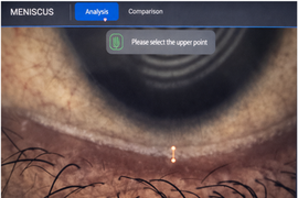 Tear Meniscus Height