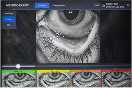 Meibomian Gland Analysis