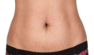 Woman Showing Stretch Marks..jpg