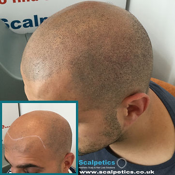 Scalp Micropigmentation Hair Tattoo Follicle Simulation Tricopigmentation Hair Transplant Hair Restoration Hair Recovery Treatment for Alopecia Areata, Alopecia Universalis, Alopecia Totalis, Chemotherapy, Cancer Treatments, HRT Hormone Replacement Female Pattern Baldness, Male Pattern Baldness, Balding Thinning Hair Hairloss at Scalpetics in Hitchin Hertfordshire near North London, Cambridgeshire, Bedfordshire, Essex, Middlesex, Stevenage, Royston, Biggleswade, Cambridge St Neots, St Albans, Hatfield, Harpenden Watford Hemel Hempstead, Dunstable, Milton Keynes Bedford LutonLetchworth Welwyn Garden City, Bishops Stortford Chelmsford Barnet, Enfield Hampstead