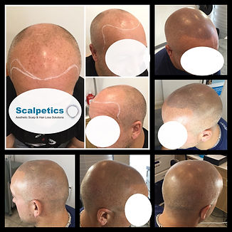 going bald alopecia male and female pattern baldness UK london hertfordshire