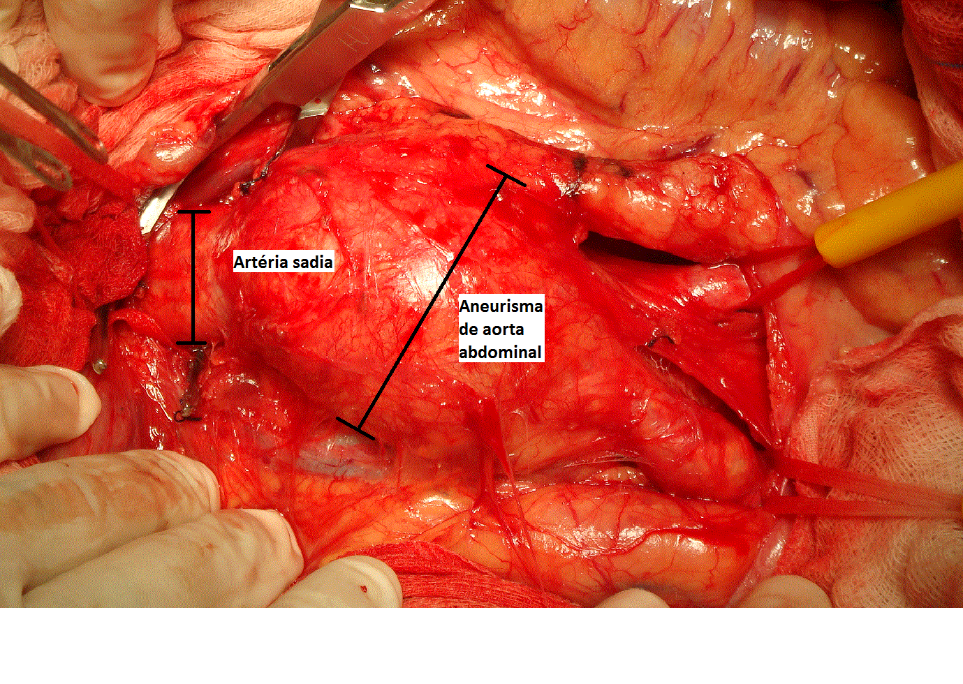 aneurisma de aorta.gif