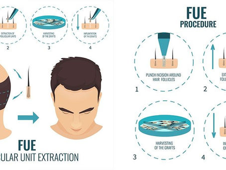 ­Best Hair Transplant Clinic in Kolkata Explains Perfect Hair Transplant Candidate­­­