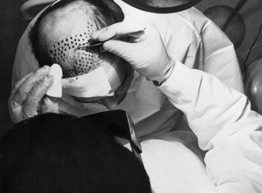 hair transplant
