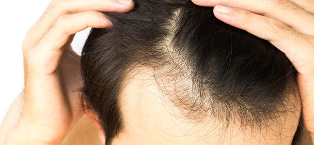 hair transplant in Kolkata 
