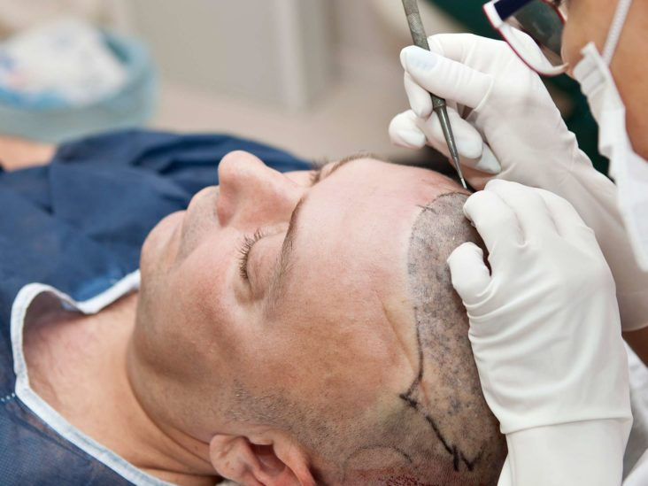 hair transplant in India 