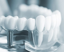 implante-dental.png