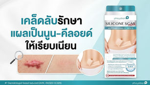 เคล็ดลับรักษาแผลเป็นนูน-คีลอยด์ ให้เรียบเนียน ทำไม "ความบางและใส่สบาย" ของแผ่นซิลิโคน คือกุญแจสำคัญที่ทำให้แผลหายไว?