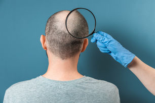 Hair Restoration Injections for Men's Hair Loss: A Promising Solution
