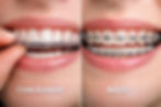 aligners.jpeg