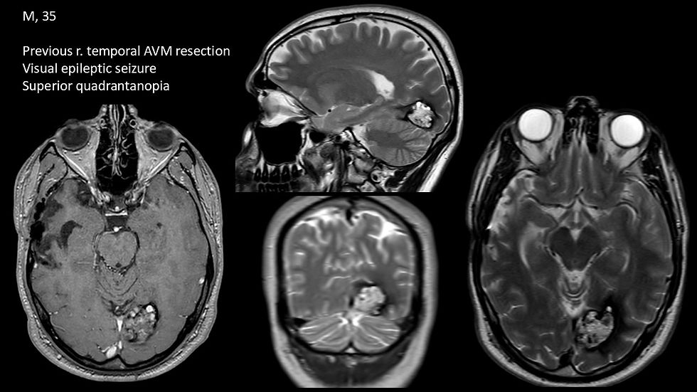 RM pre op di un paziente con Angioma Cavernoso Occipitale