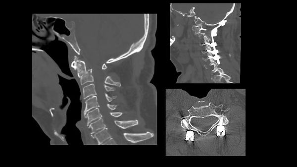 Frattura di C2 inveterata (Artrodesi Occipito-cervicale).jpg